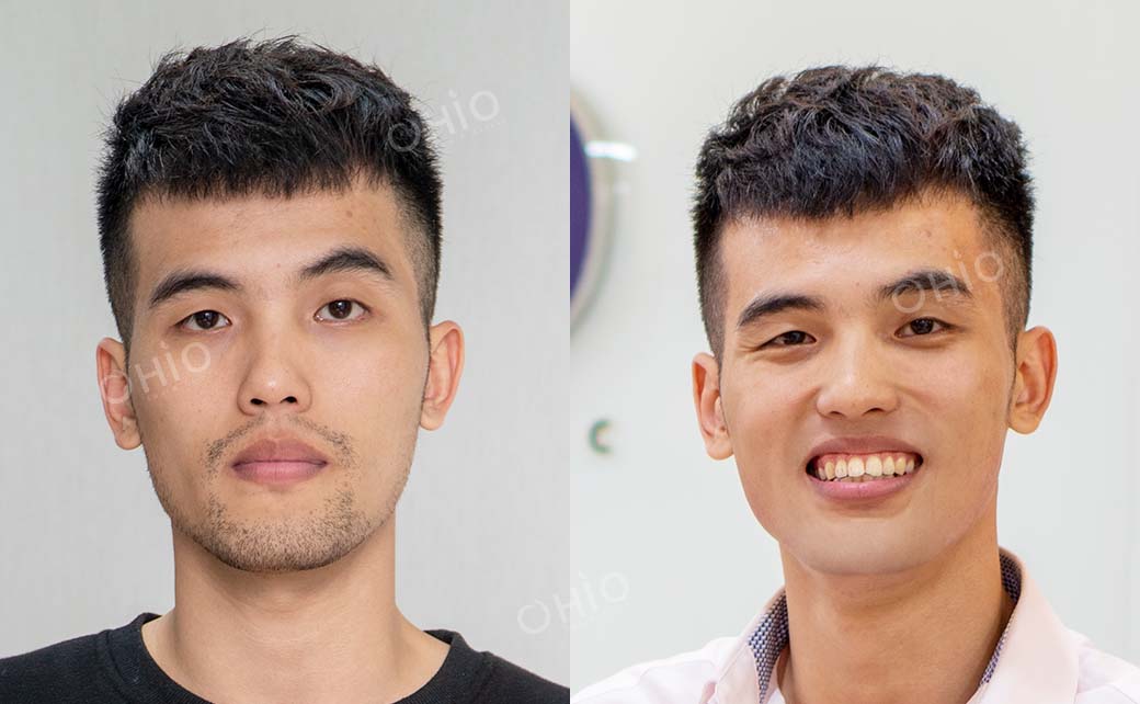 Kết quả sau dịch vụ 3