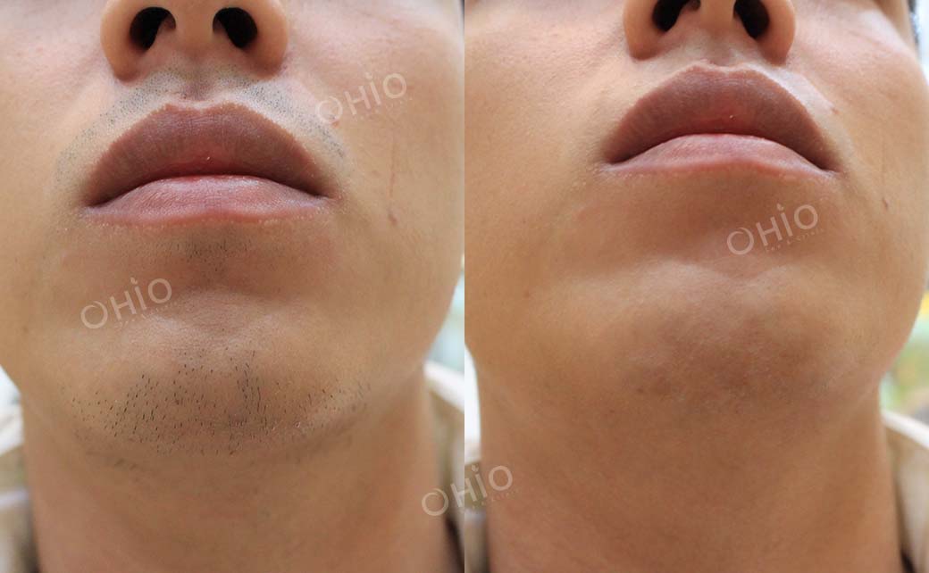 Kết quả sau dịch vụ 6