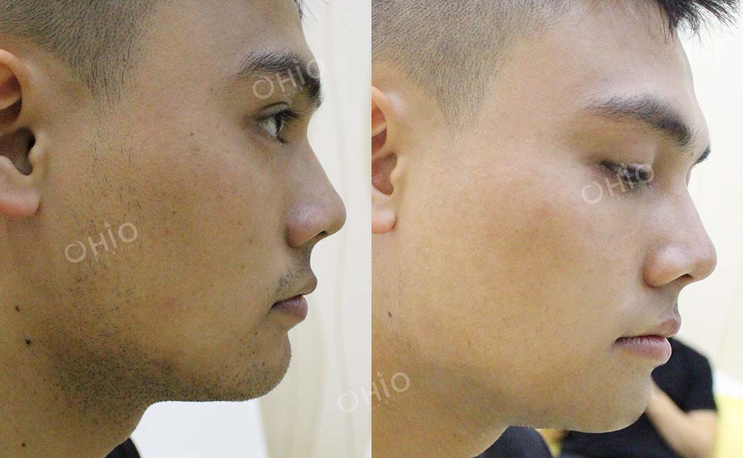 Kết quả sau dịch vụ 5