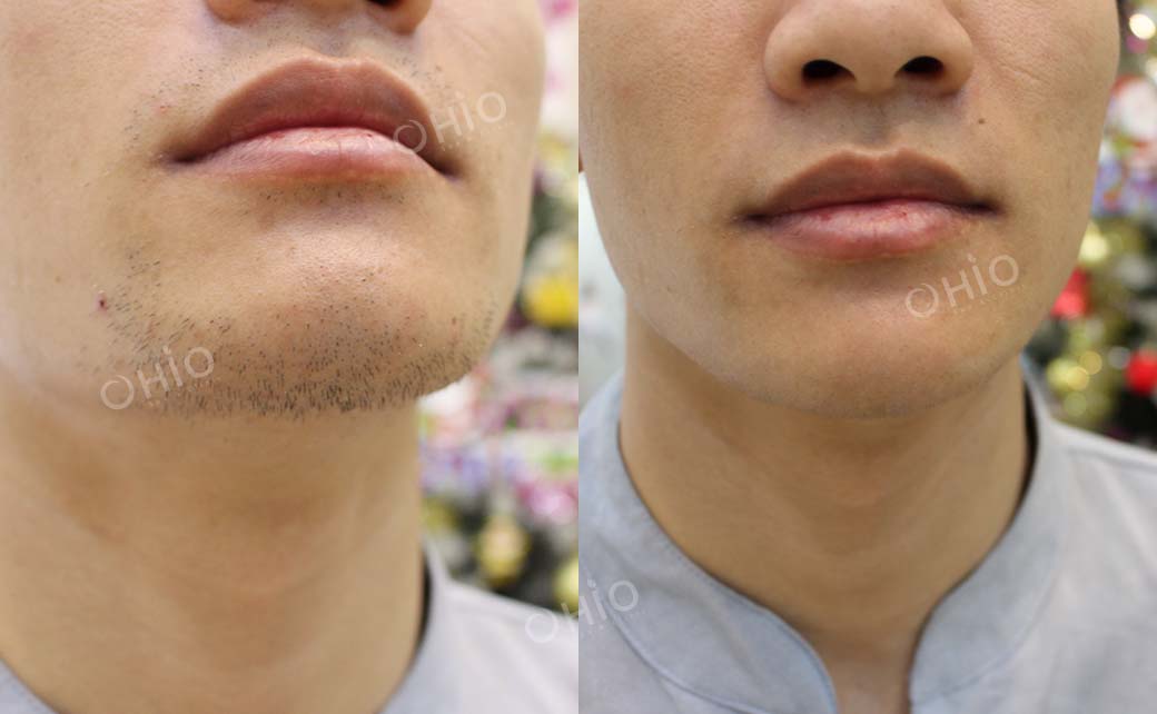 Kết quả sau dịch vụ 6