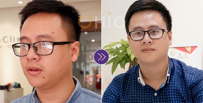 Tẩy nốt ruồi bằng laser công nghệ cao - Phòng khám da liễu OHIO Tẩy nốt ruồi bằng laser công nghệ cao