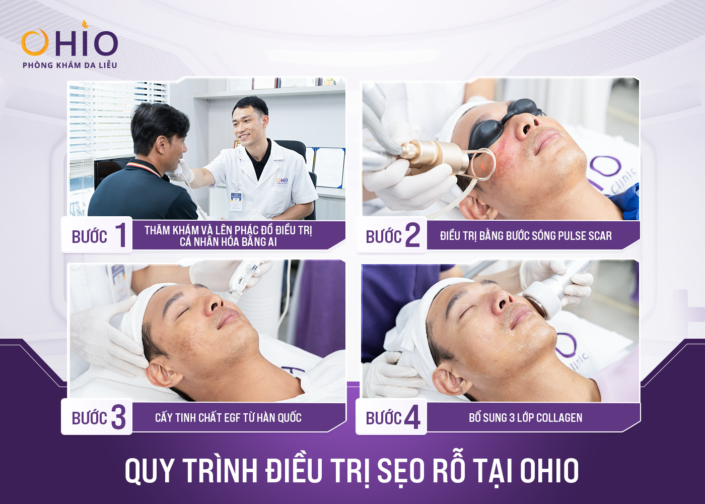 Điều trị sẹo thủy đậu hiệu quả cao - Phòng khám da liễu OHIO Quy trình trị sẹo tại phòng khám OHIO