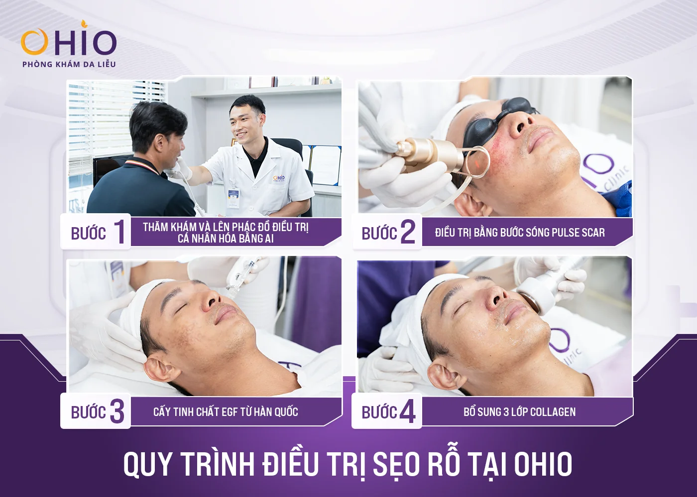 Điều trị sẹo thủy đậu hiệu quả cao - Phòng khám da liễu OHIO Quy trình trị sẹo tại phòng khám OHIO