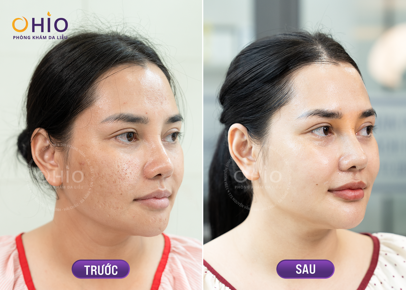 Điều trị sẹo thủy đậu hiệu quả cao - Phòng khám da liễu OHIO Khách hàng điều trị sẹo tại phòng khám OHIO