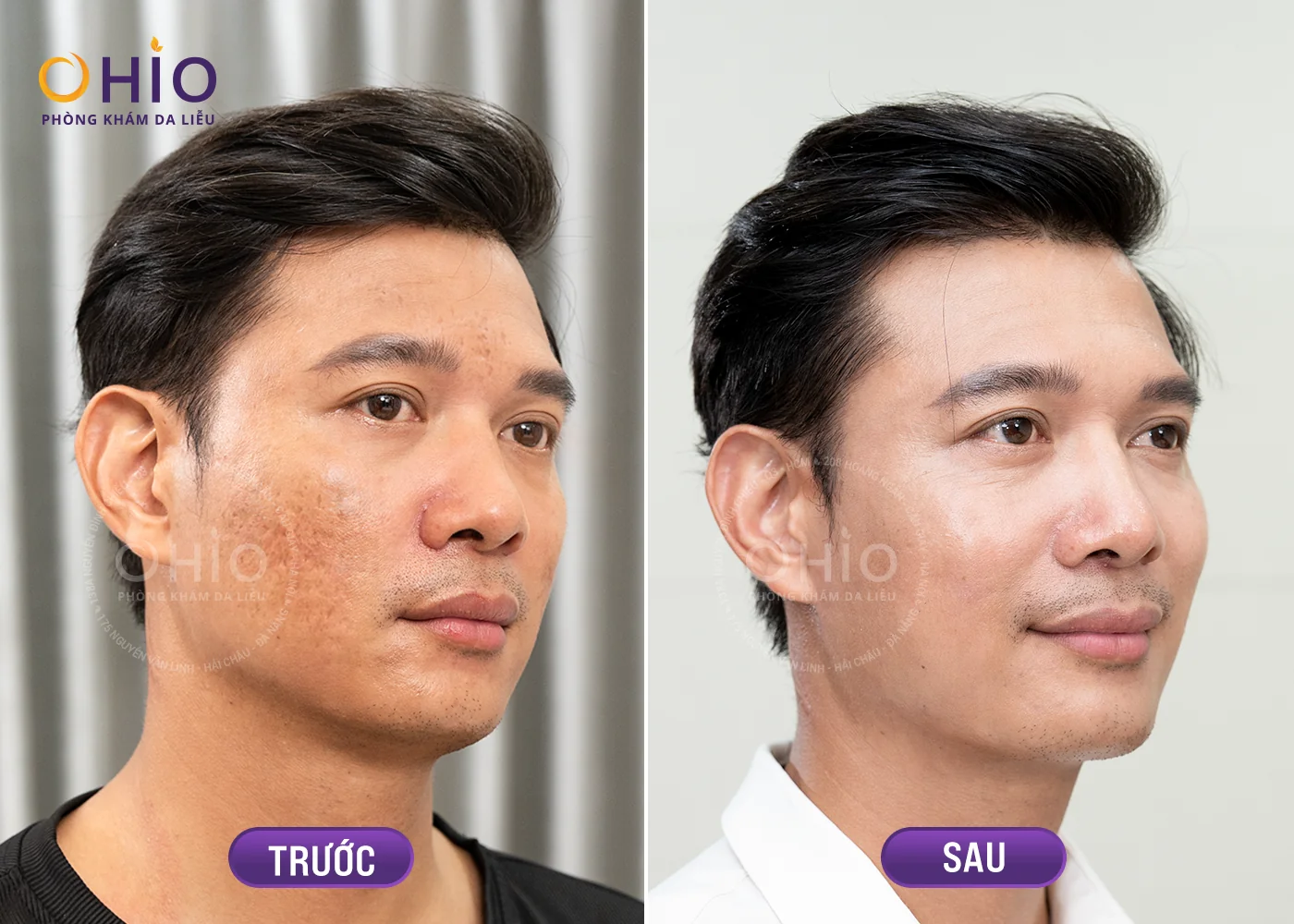 Điều trị sẹo thủy đậu hiệu quả cao - Phòng khám da liễu OHIO Khách hàng điều trị sẹo tại phòng khám OHIO