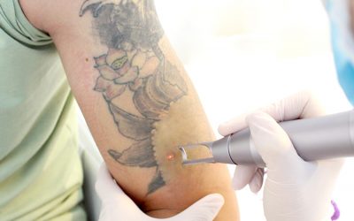 Phương pháp xóa xăm bằng Laser - Phòng khám da liễu OHIO Phương pháp xóa xăm bằng Laser