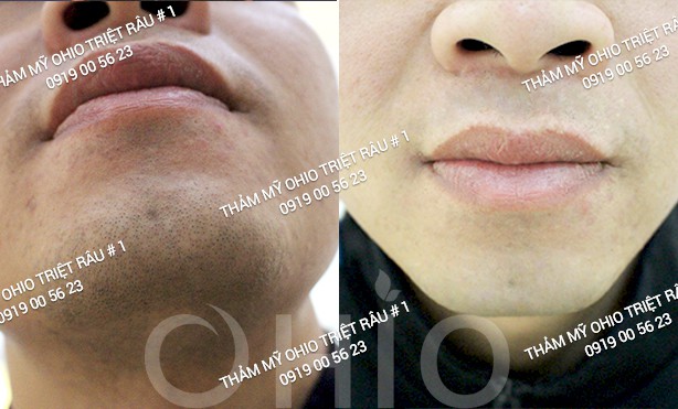 Triệt lông giá bao nhiêu - Phòng khám da liễu OHIO Triệt lông giá bao nhiêu