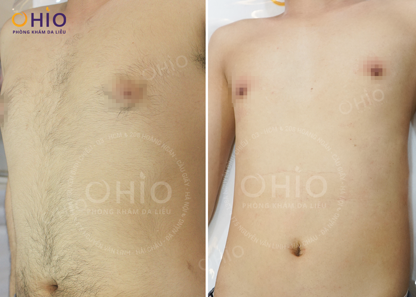 Xóa sạch các vùng lông rậm, cứng với địa chỉ triệt lông tốt ở Hà Nội dành cho nam - Phòng khám da liễu OHIO Kết quả triệt lông của khách hàng tại phòng khám OHIO