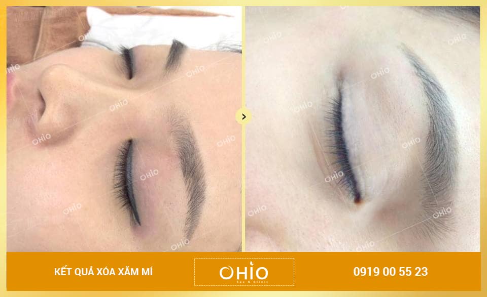 Xóa xăm mí mắt