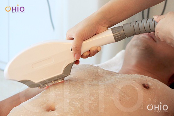 triet-long-ipl Tìm hiểu về các công nghệ triệt lông cho nam công nghệ cao