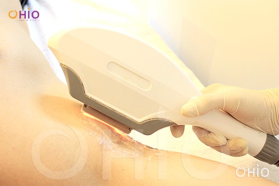 triet-long-bang-laser triệt lông an toàn 2