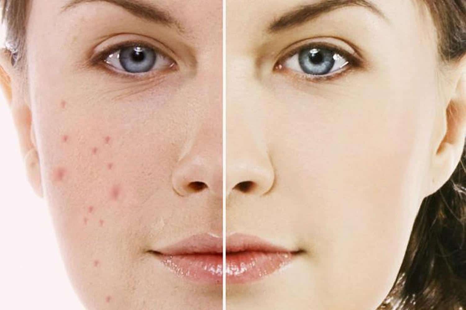tri-mun-o-dau-tot 7 điều cần biết để trị mụn hiệu quả