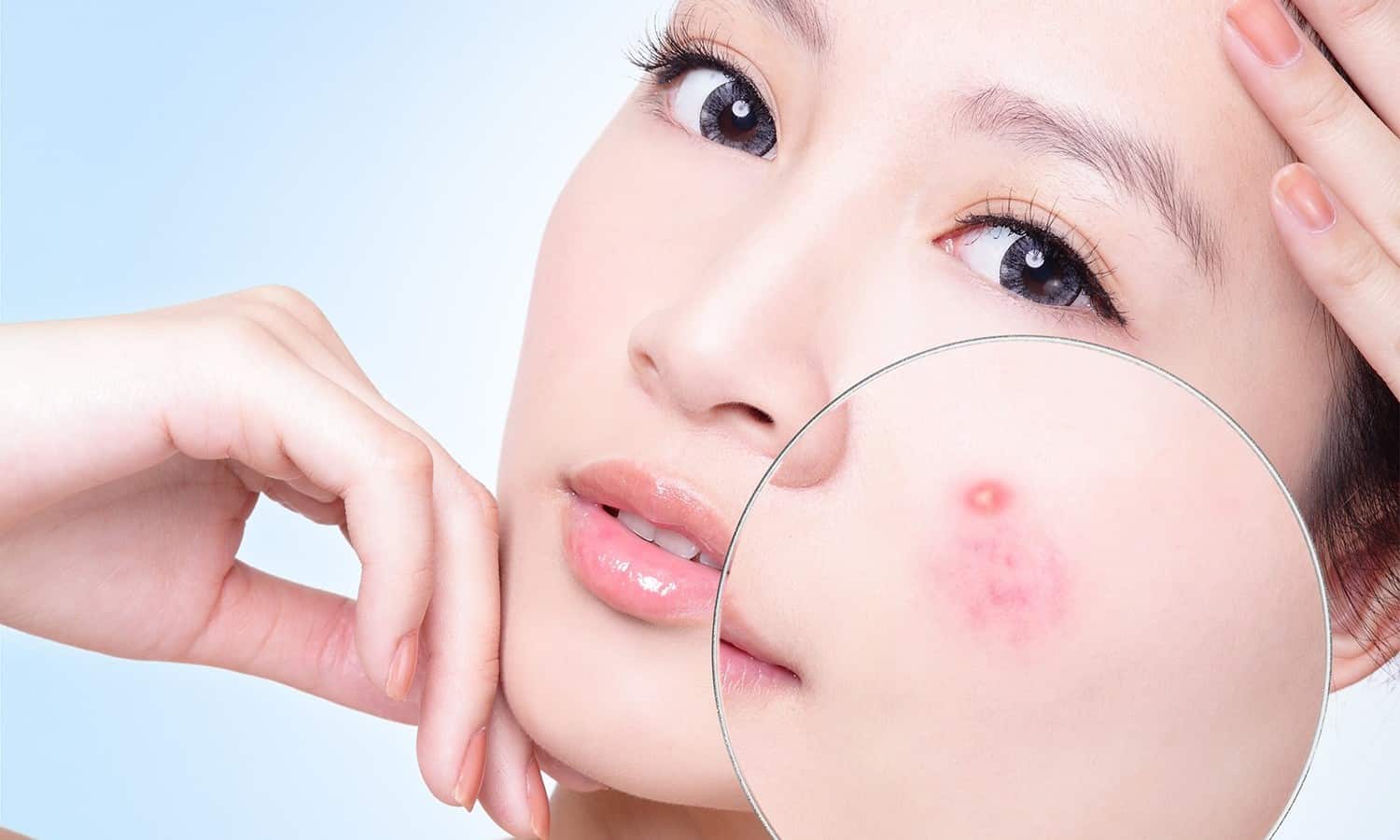 tri-mun 7 điều cần biết để trị mụn hiệu quả