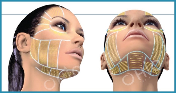 Ultherapy tác động sâu giúp xóa nhăn và nâng cơ an toàn hiệu quả