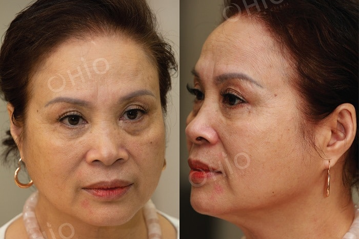 Da bị lão hóa do tuổi tác cần can thiệp chuyên sâu