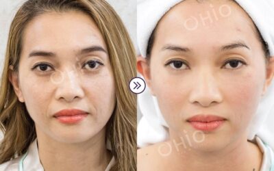 nâng cơ xóa nhăn hiệu quả với công nghệ cao tại Ohio Spa