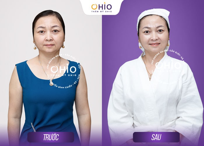 Cấy tinh chất Mulwang trẻ hóa da chuẩn Hàn - Phòng khám da liễu OHIO Cấy tinh chất Mulwang trẻ hóa da chuẩn Hàn