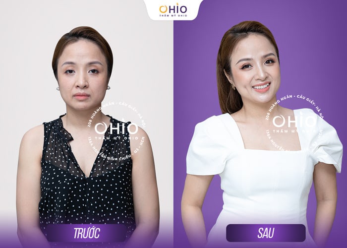 Cấy tinh chất Mulwang trẻ hóa da chuẩn Hàn - Phòng khám da liễu OHIO Cấy tinh chất Mulwang trẻ hóa da chuẩn Hàn