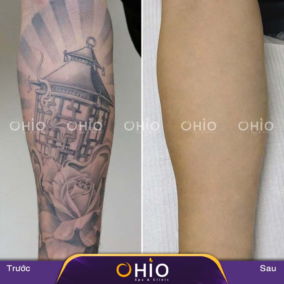 Những điều cần lưu ý khi xóa xăm thi tuyển ngành công an - Phòng khám da liễu OHIO Những điều cần lưu ý khi xóa xăm thi tuyển ngành công an