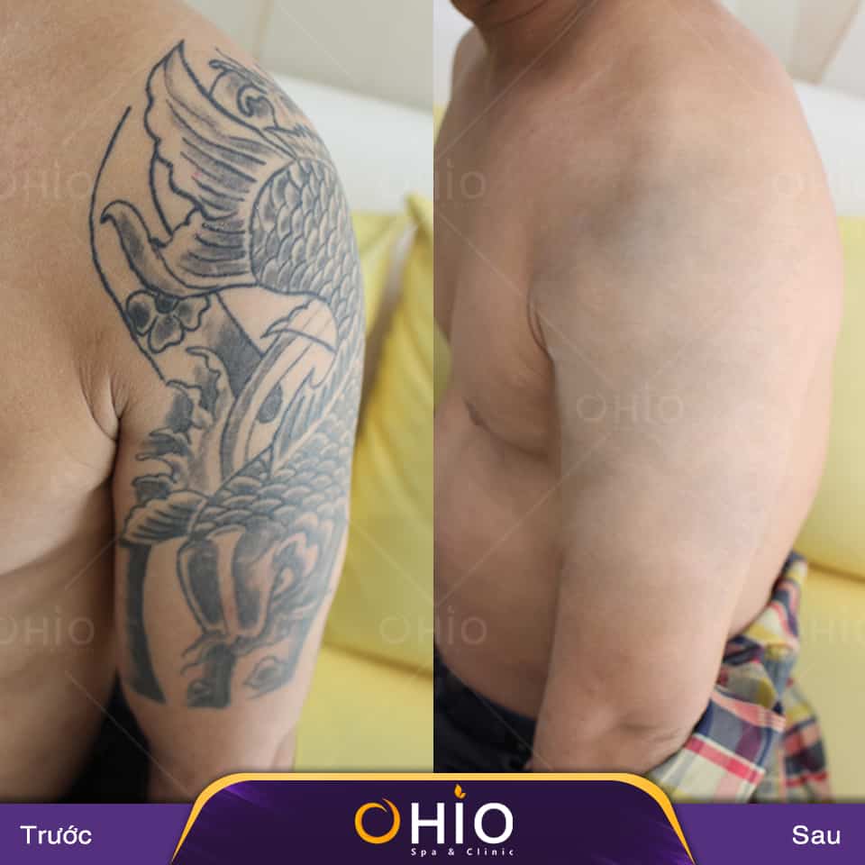 Những điều cần lưu ý khi xóa xăm thi tuyển ngành công an - Phòng khám da liễu OHIO Những điều cần lưu ý khi xóa xăm thi tuyển ngành công an