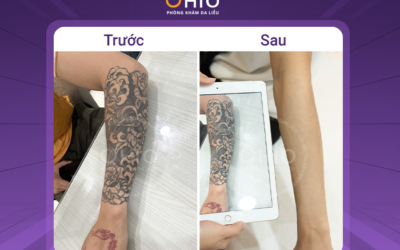 Các phương pháp xóa xăm hiện nay, cách nào an toàn và hiệu quả? - Phòng khám da liễu OHIO Các phương pháp xóa xăm hiện nay, cách nào an toàn và hiệu quả?