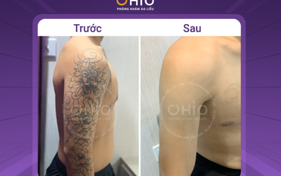 Các phương pháp xóa xăm hiện nay, cách nào an toàn và hiệu quả? - Phòng khám da liễu OHIO Các phương pháp xóa xăm hiện nay, cách nào an toàn và hiệu quả?