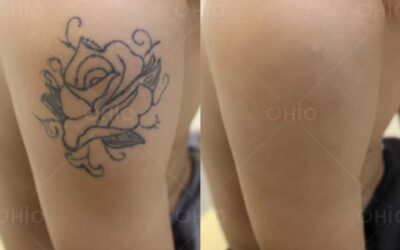 Xóa xăm bằng laser có tốt không? Những điều cần biết về xóa xăm bằng laser - Phòng khám da liễu OHIO Kết quả xóa xăm bằng la de