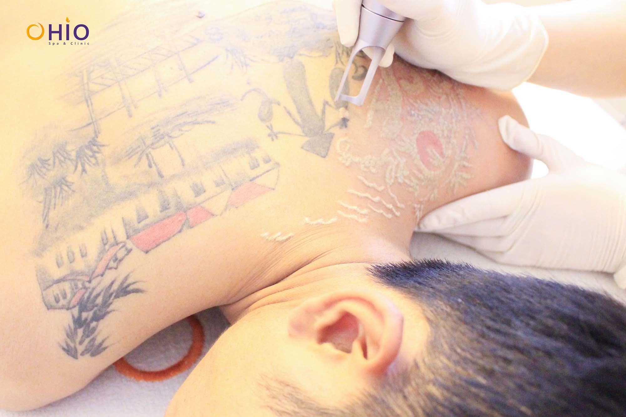 Xóa xăm bằng laser có tốt không? Những điều cần biết về xóa xăm bằng laser - Phòng khám da liễu OHIO Xóa xăm bằng laser