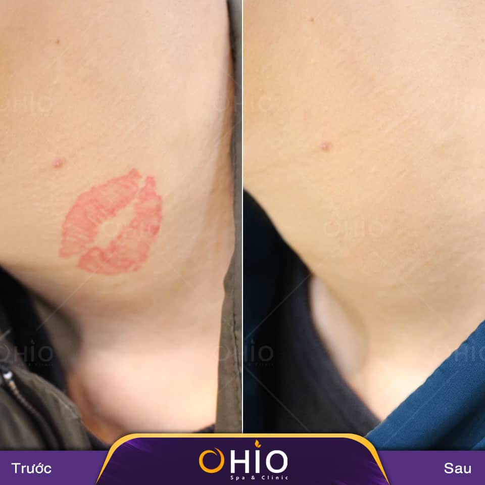 Những điều cần lưu ý khi xóa xăm thi tuyển ngành công an - Phòng khám da liễu OHIO Những điều cần lưu ý khi xóa xăm thi tuyển ngành công an