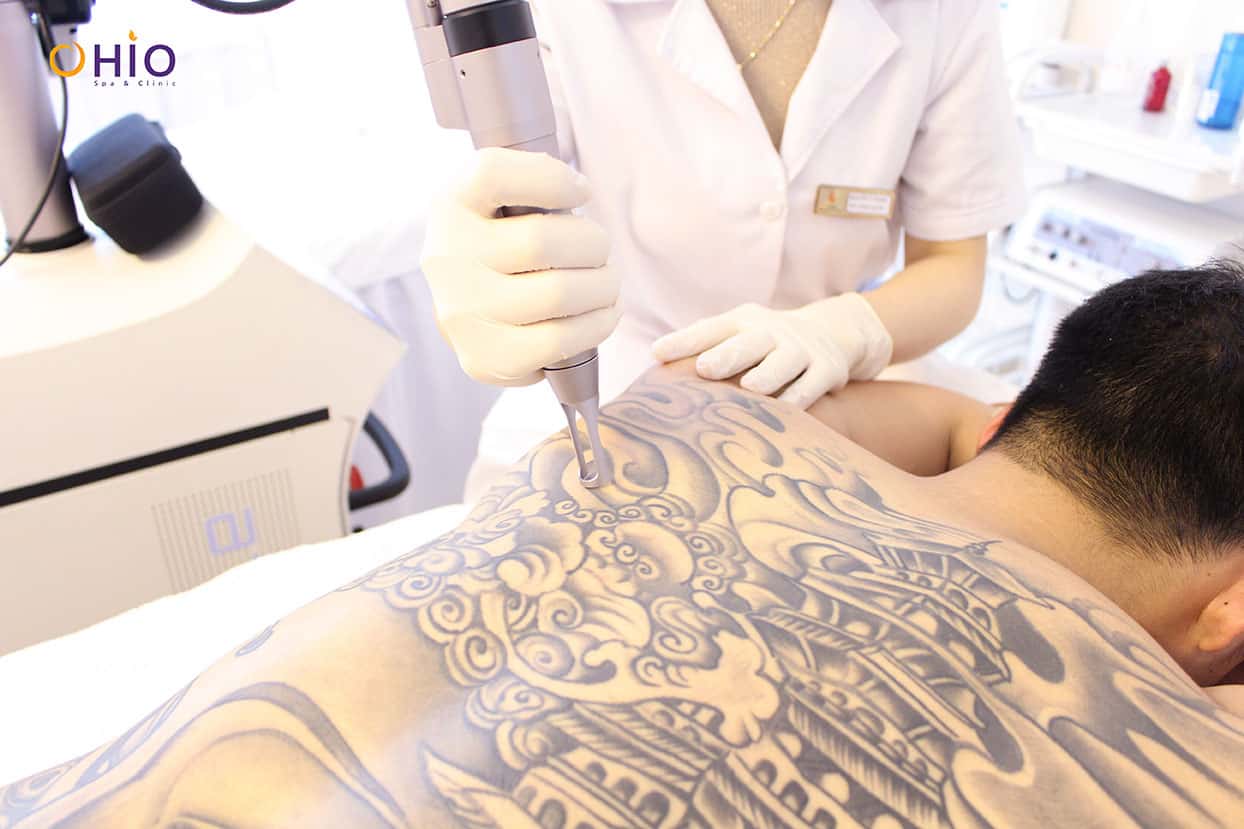 Những điều cần lưu ý khi xóa xăm thi tuyển ngành công an - Phòng khám da liễu OHIO Những điều cần lưu ý khi xóa xăm thi tuyển ngành công an