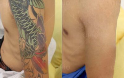 Xóa xăm bằng laser có tốt không? Những điều cần biết về xóa xăm bằng laser - Phòng khám da liễu OHIO Kết quả xóa xăm bằng Lade