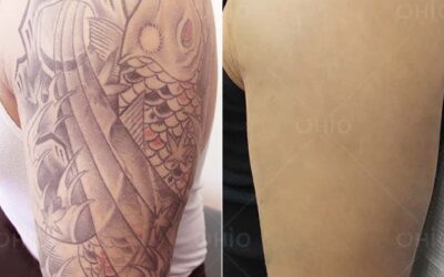 Xóa xăm bằng laser có tốt không? Những điều cần biết về xóa xăm bằng laser - Phòng khám da liễu OHIO ket qua xoa xam bang laser