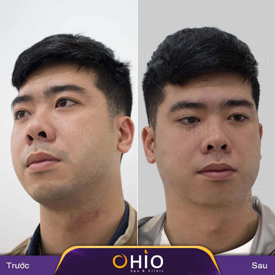 Triệt lông nam giới và triệt lông nữ giới có gì khác nhau? - Phòng khám da liễu OHIO Kết quả triệt râu tại Ohio Spa