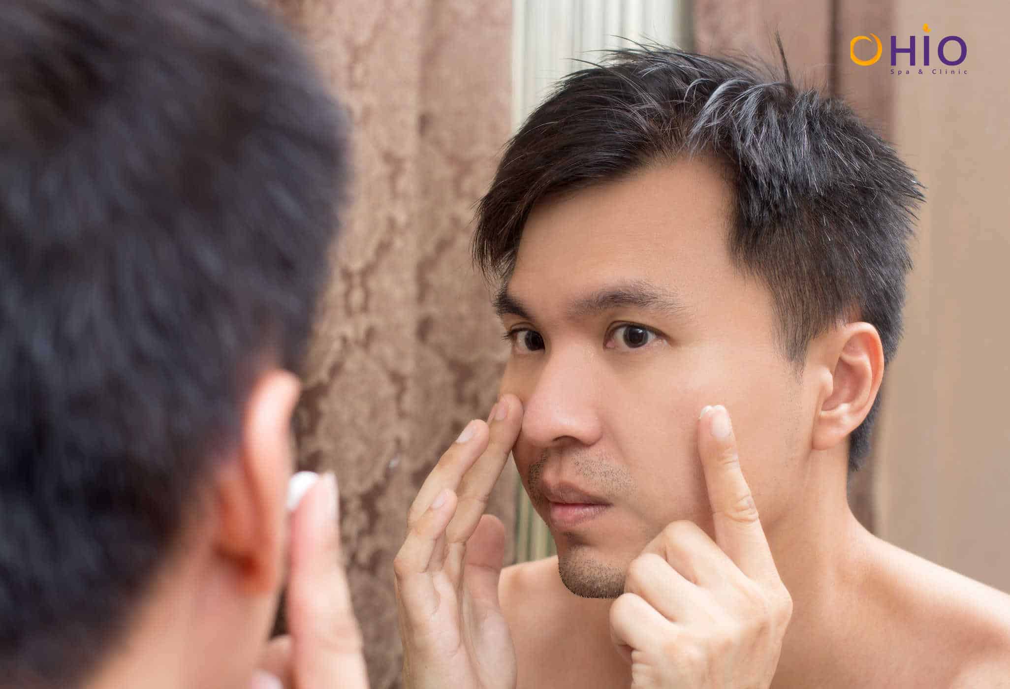 Trị mụn nam giới