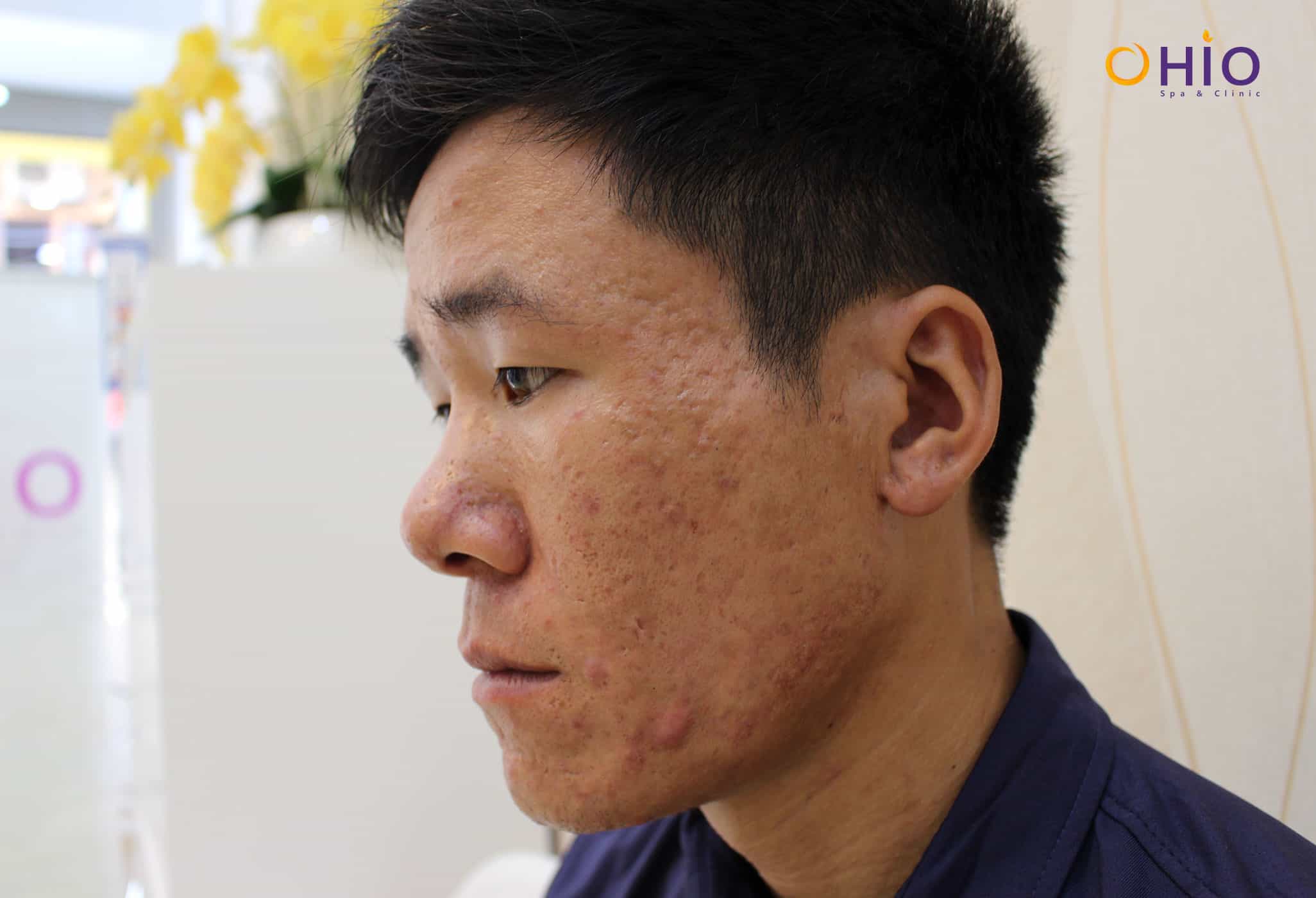 Trị mụn nam ở đâu thì tốt?