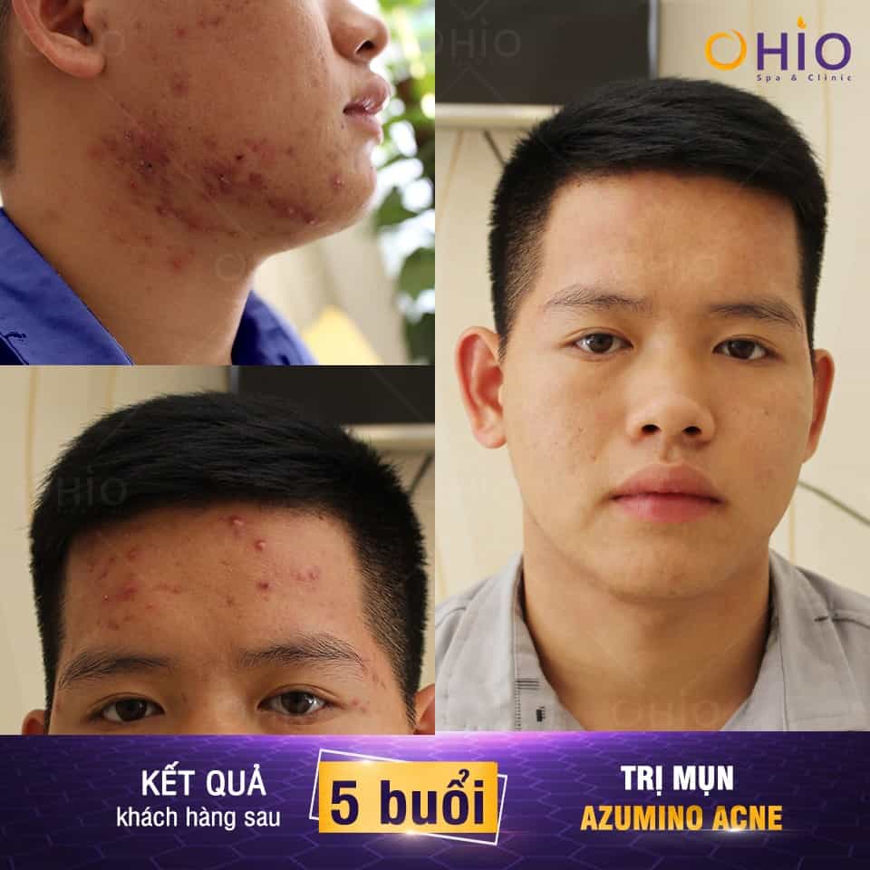 Trị mụn nam ở đâu thì tốt?