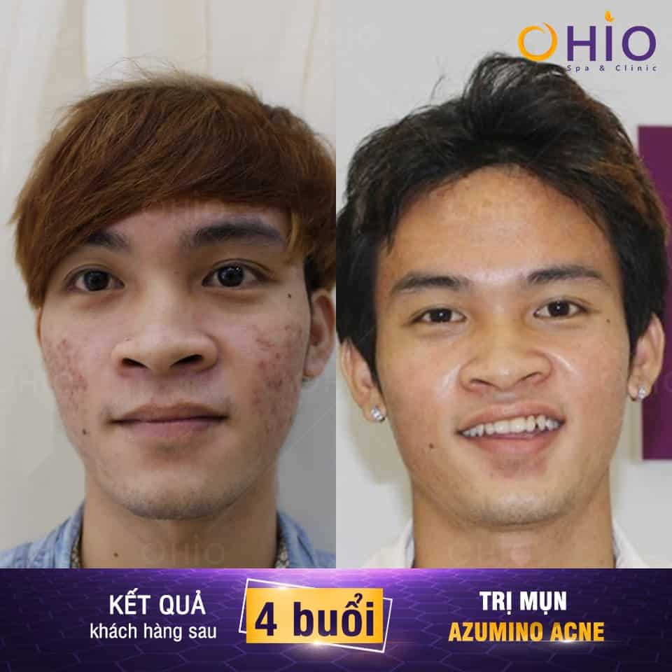 Trị mụn nam ở đâu thì tốt?