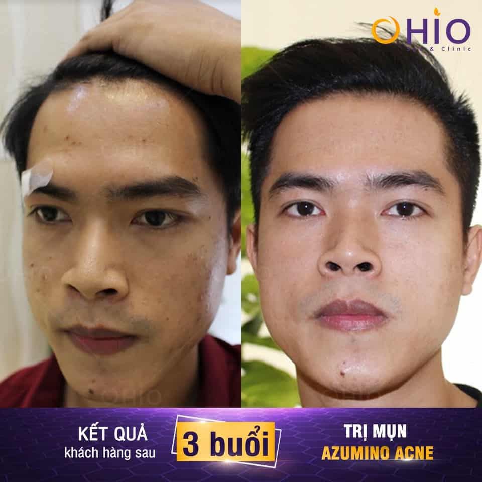 Trị mụn nam ở đâu thì tốt?