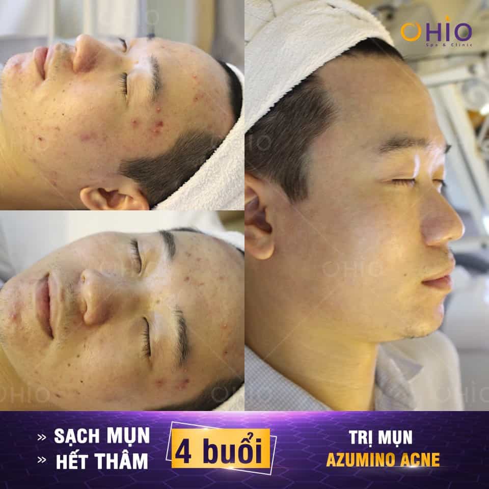 Trị mụn nam ở đâu thì tốt?