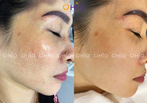 Trị giãn mao mạch Mercury LX - Vị trí nào cũng sạch - Phòng khám da liễu OHIO Kết quả trị giãn mao mạch má Ohio Spa 116 Hoàng Ngân