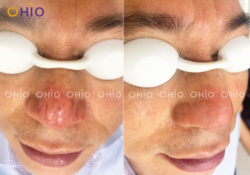 Trị giãn mao mạch Mercury LX - Vị trí nào cũng sạch - Phòng khám da liễu OHIO Kết quả trị giãn mao mạch Ohio Spa 116 Hoàng Ngân
