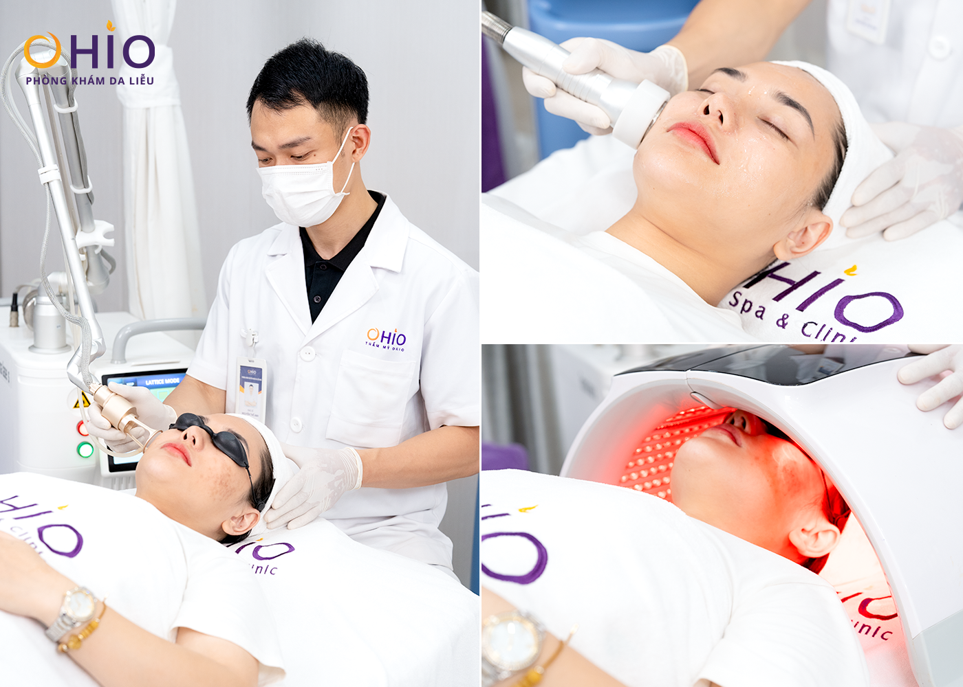 Phương pháp điều trị sẹo rỗ 