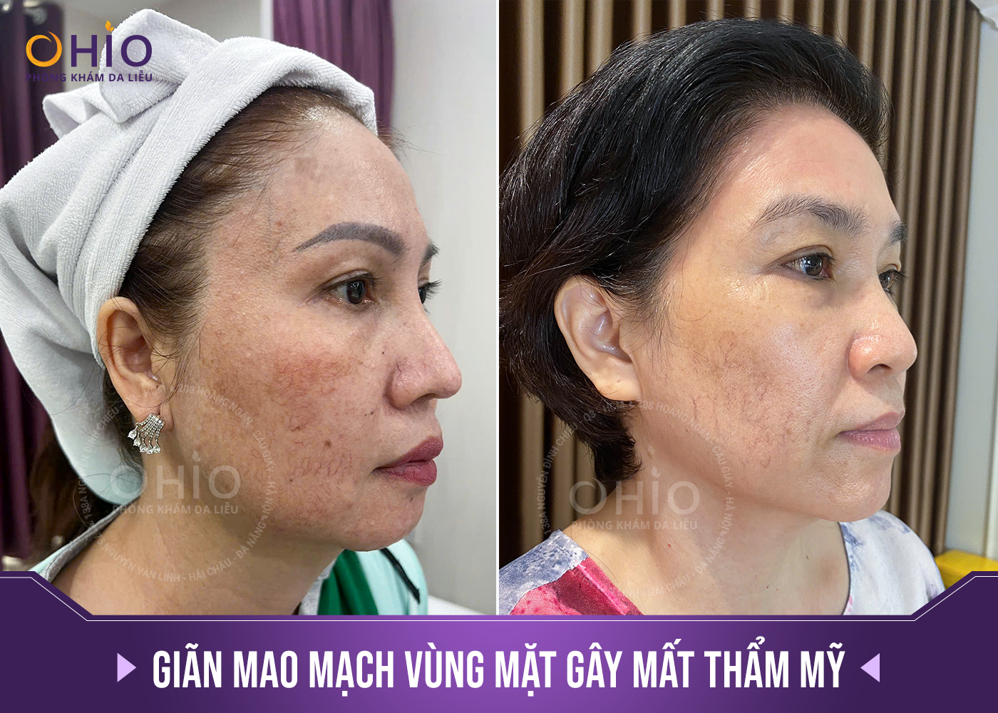 Trị giãn mao mạch ở đâu thì chấm dứt, da đẹp không tì vết? - Phòng khám da liễu OHIO Trị giãn mao mạch ở đâu thì chấm dứt, da đẹp không tì vết?