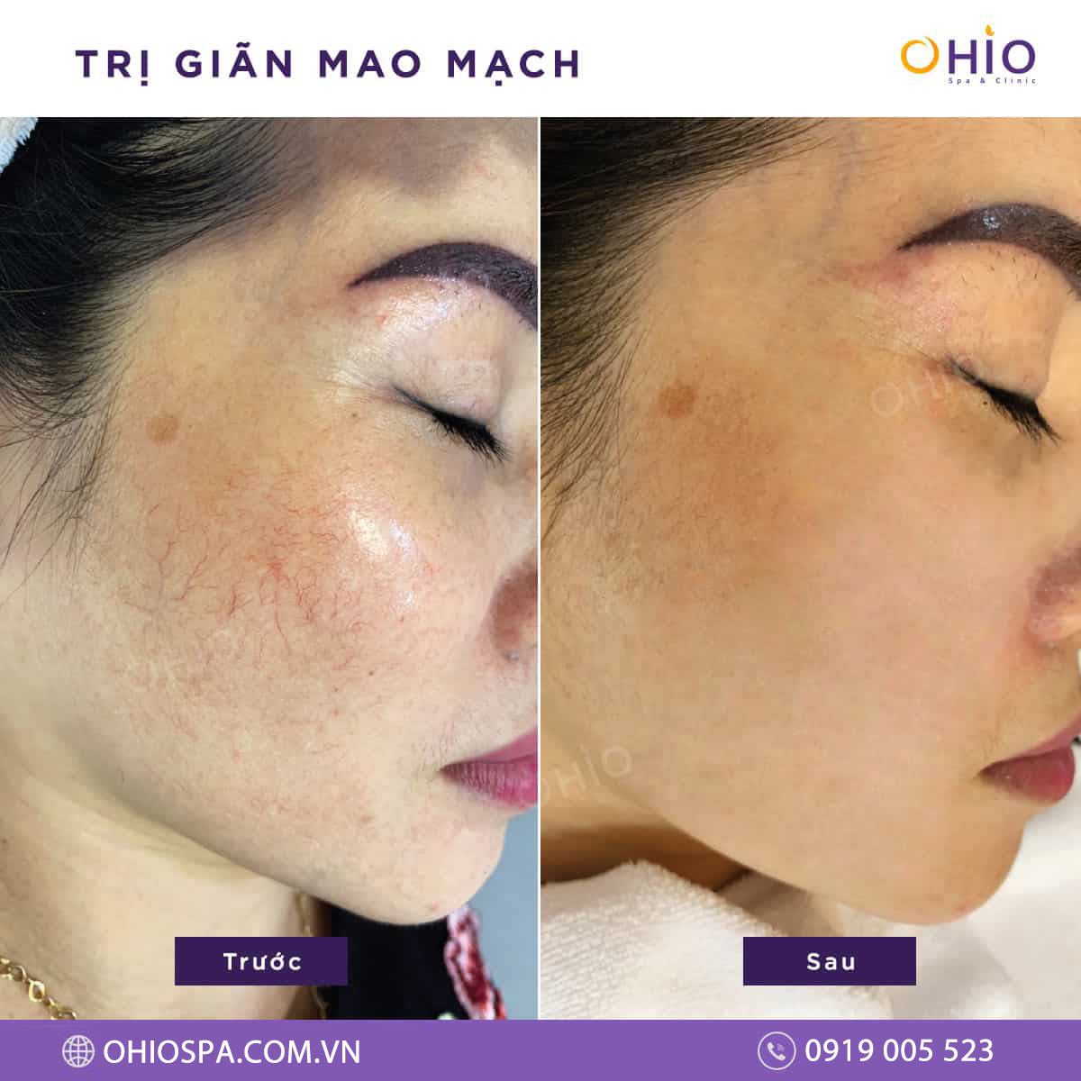 Trị giãn mao mạch bằng tiêm chích xơ và Laser xung dài loại nào tốt hơn? - Phòng khám da liễu OHIO Trị giãn mao mạch bằng tiêm chích xơ và Laser xung dài loại nào tốt hơn?