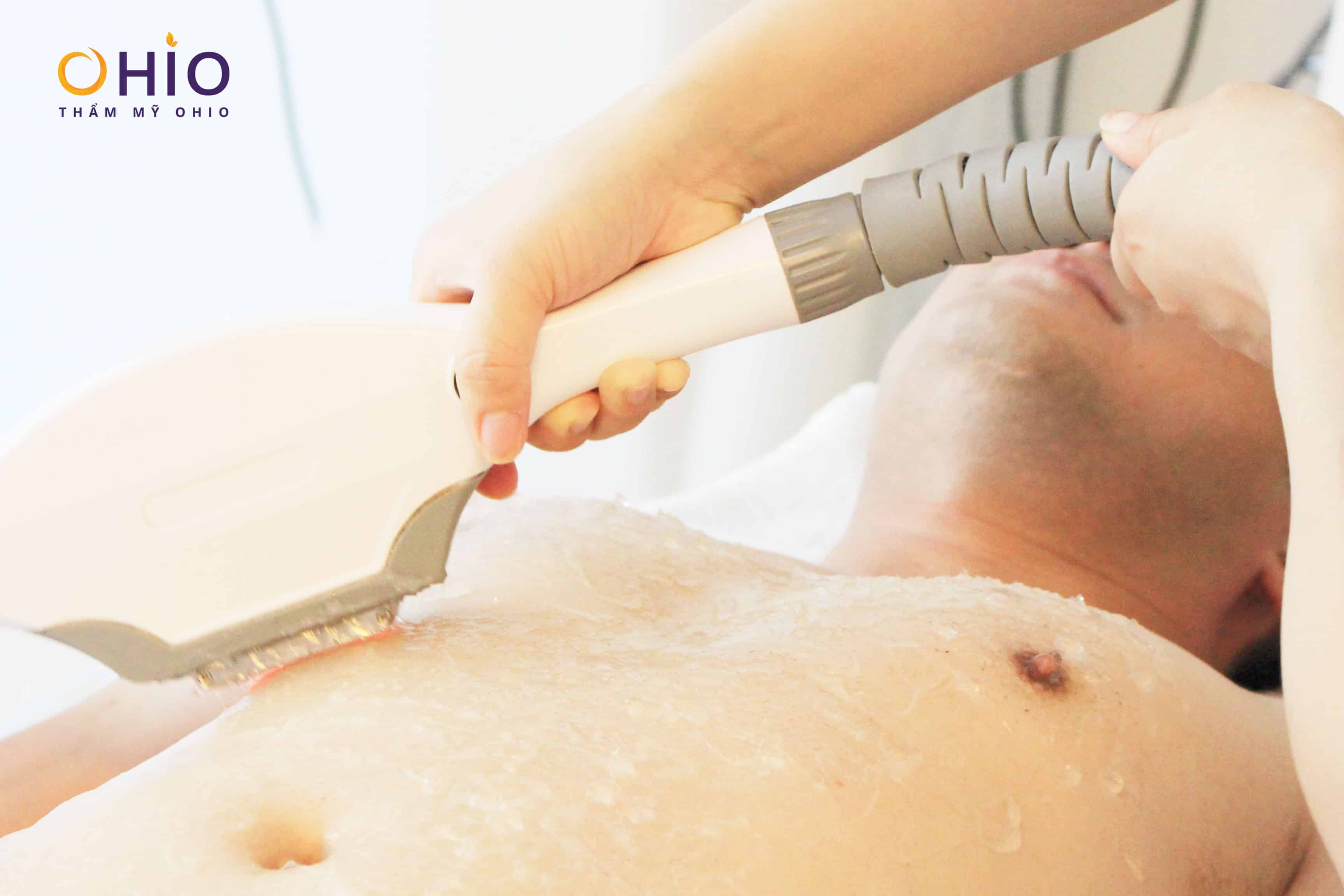 Diode Laser M3 - công nghệ triệt lông chuyên sâu đầu tiên dành cho nam giới! - Phòng khám da liễu OHIO Diode Laser M3 - công nghệ triệt lông chuyên sâu đầu tiên dành cho nam giới!