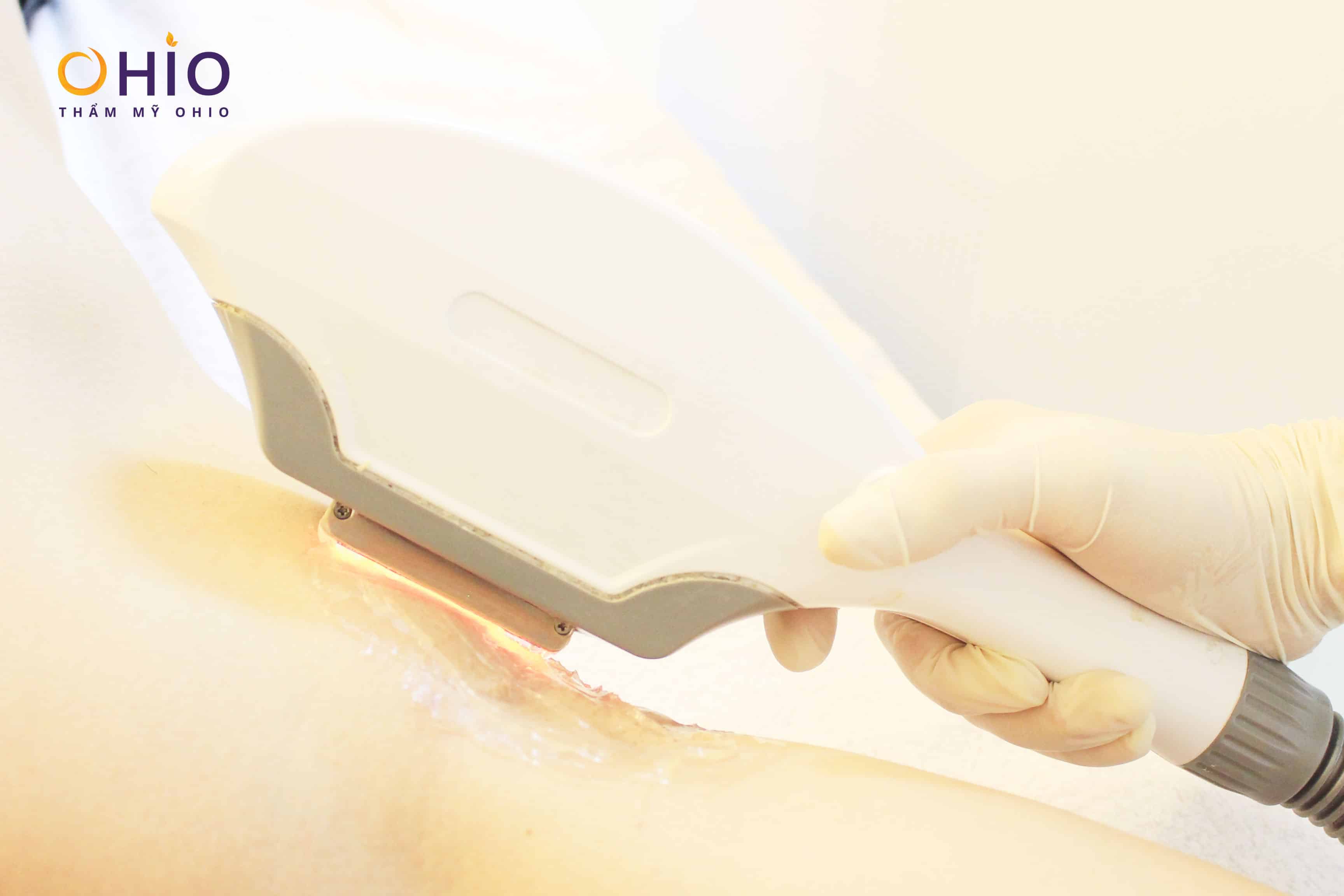 Diode Laser M3 - công nghệ triệt lông chuyên sâu đầu tiên dành cho nam giới! - Phòng khám da liễu OHIO Diode Laser M3 - công nghệ triệt lông chuyên sâu đầu tiên dành cho nam giới!