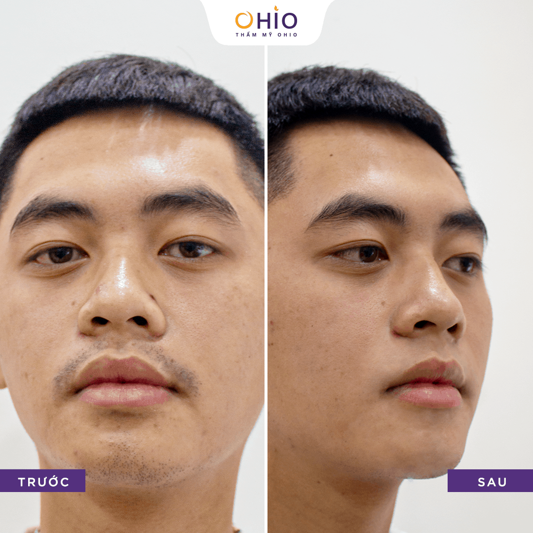 Diode Laser M3 - công nghệ triệt lông chuyên sâu đầu tiên dành cho nam giới! - Phòng khám da liễu OHIO Diode Laser M3 - công nghệ triệt lông chuyên sâu đầu tiên dành cho nam giới!