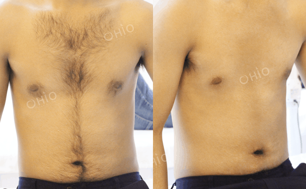 Diode Laser M3 - công nghệ triệt lông chuyên sâu đầu tiên dành cho nam giới! - Phòng khám da liễu OHIO Diode Laser M3 - công nghệ triệt lông chuyên sâu đầu tiên dành cho nam giới!