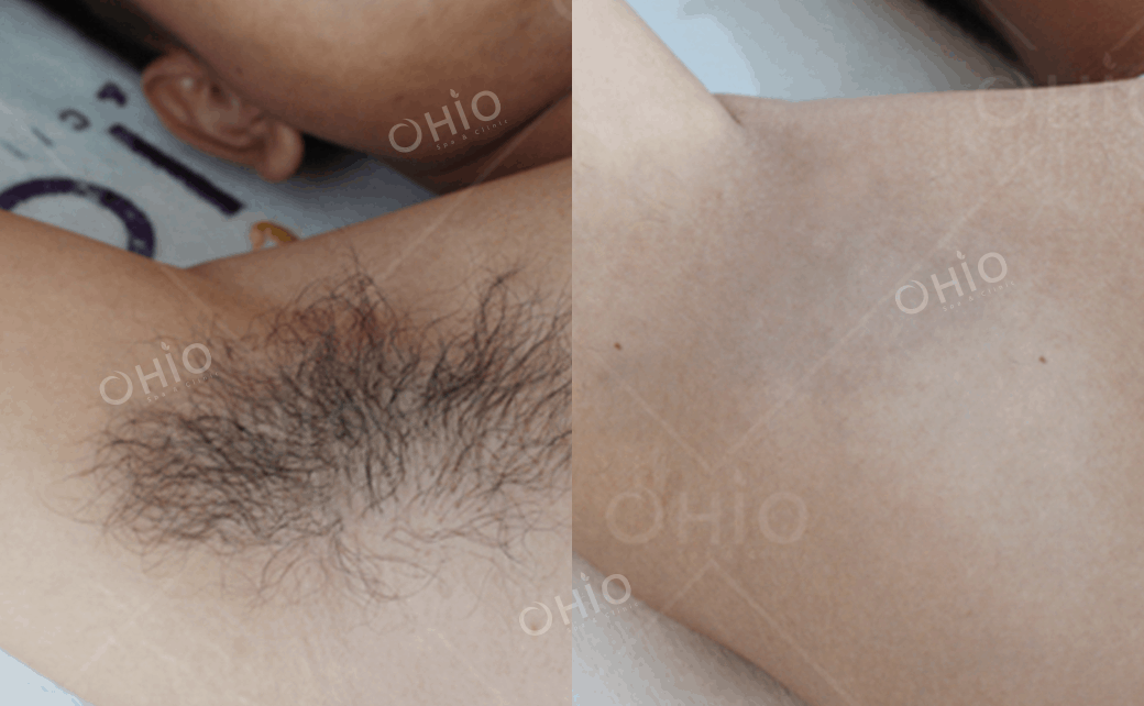 Diode Laser M3 - công nghệ triệt lông chuyên sâu đầu tiên dành cho nam giới! - Phòng khám da liễu OHIO Diode Laser M3 - công nghệ triệt lông chuyên sâu đầu tiên dành cho nam giới!