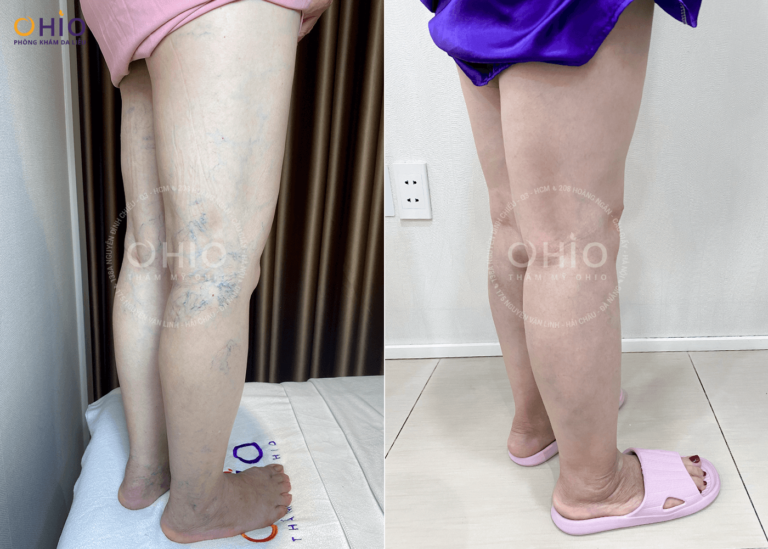 Trị giãn mao mạch ở đâu thì chấm dứt, da đẹp không tì vết? - Phòng khám da liễu OHIO Trị giãn mao mạch ở đâu thì chấm dứt, da đẹp không tì vết?